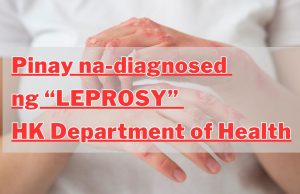 Pinay na-diagnosed ng “Leprosy”, HK Department of Health Pinay na-diagnosed ng “Leprosy”, HK Department of Health