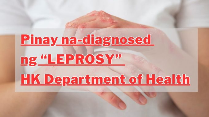 Pinay na-diagnosed ng “Leprosy”, HK Department of Health Pinay na-diagnosed ng “Leprosy”, HK Department of Health